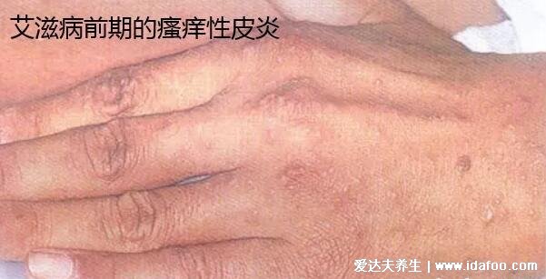 男性艾滋病的10個征兆，注意異常的初期癥狀和身體反應