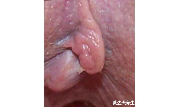 痔瘡長什么樣子的圖片，真實的輕微痔瘡圖片大全