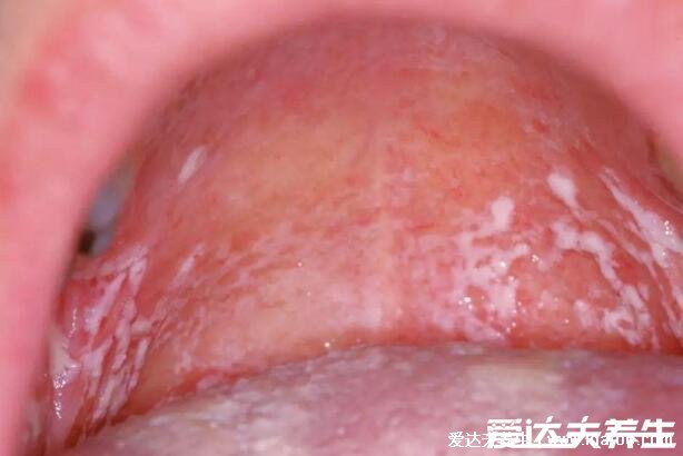 初早期嬰兒鵝口瘡圖片及癥狀圖，感染輕微不疼但可進食痛苦(類似奶快)