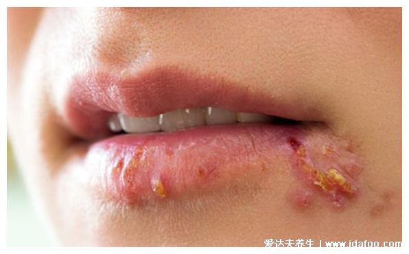 皰疹和上火水泡的區別圖片，上火引起的水泡要警惕單純皰疹病毒
