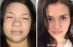 女性甲狀腺的前驅圖，甲狀腺功能減退會