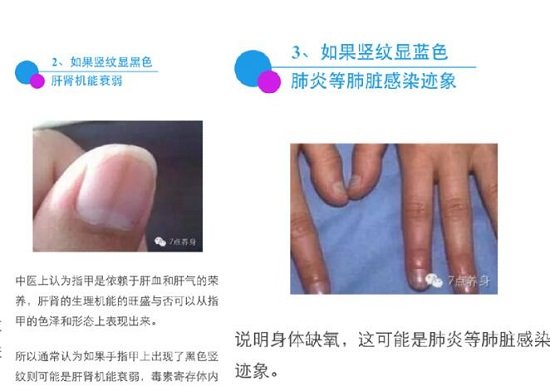 指甲有豎紋是身體的什么信號圖片，指甲豎紋當心三大疾病(注意顏色)