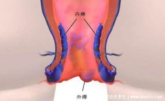 痔瘡長什么樣的圖片，輕微痔瘡真實圖片全集。