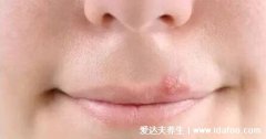 而上火引起的水泡要警惕單純皰疹病毒。