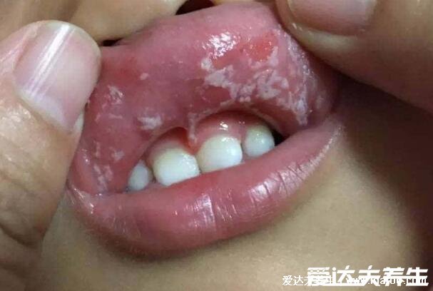 初早期嬰兒鵝口瘡圖片及癥狀圖，感染輕微不疼但可進食痛苦(類似奶快)