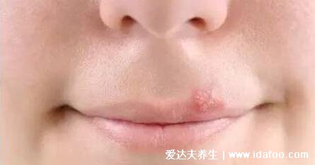 皰疹和上火水泡的區別圖片，上火引起的水泡要警惕單純皰疹病毒