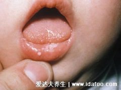 早期嬰兒鵝口瘡的圖片和癥狀，感染輕微