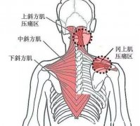 背部筋膜炎疼痛位置圖，身體背部各部位