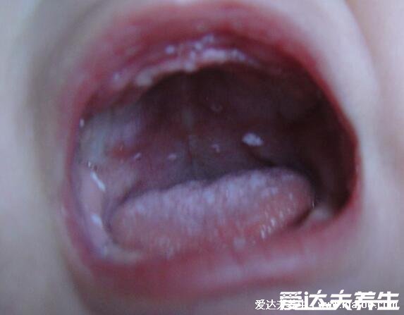 初早期嬰兒鵝口瘡圖片及癥狀圖，感染輕微不疼但可進食痛苦(類似奶快)