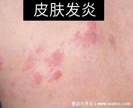 床上螨蟲咬的癥狀圖片，似蚊子包夜晚比白天瘙癢(螨蟲最怕這3種東西)