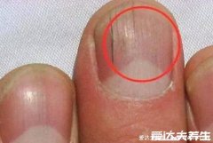 指甲有豎條紋是身體的信號圖？指甲豎條