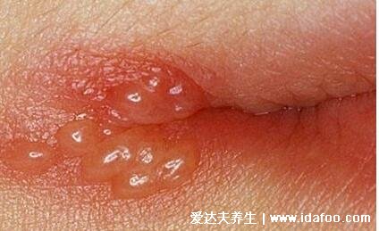 皰疹和上火水泡的區別圖片，上火引起的水泡要警惕單純皰疹病毒