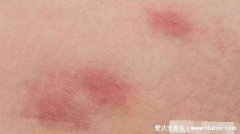 毒血熱引起的皮膚病圖片，引起各種皮疹/毛囊炎/紅斑狼瘡/銀屑病。