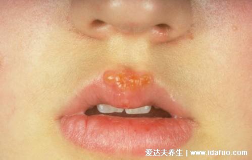 皰疹和上火水泡的區別圖片，上火引起的水泡要警惕單純皰疹病毒