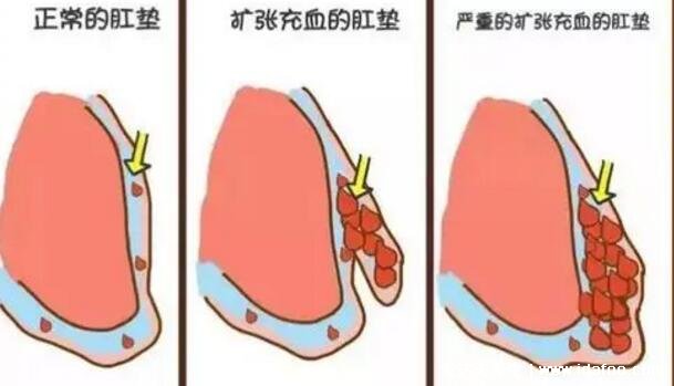 痔瘡長什么樣子的圖片，真實的輕微痔瘡圖片大全