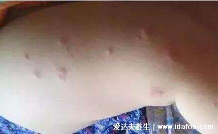 床上螨蟲咬的癥狀圖片，似蚊子包夜晚比白天瘙癢(螨蟲最怕這3種東西)