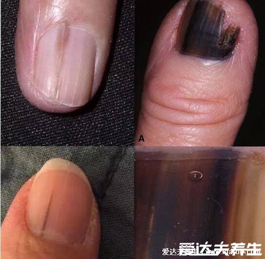 指甲有豎紋是身體的什么信號圖片，指甲豎紋當心三大疾病(注意顏色)