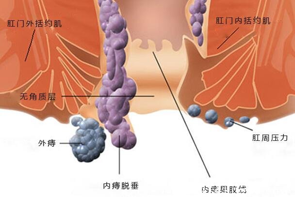 痔瘡長什么樣子的圖片，真實的輕微痔瘡圖片大全