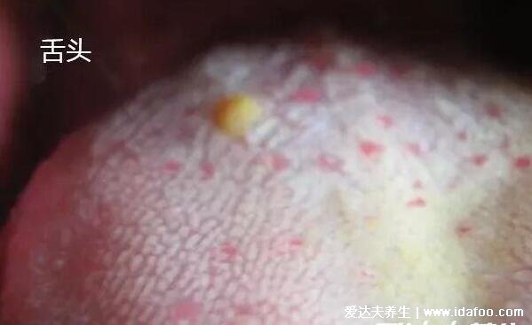 男性艾滋病的10個征兆，注意異常的初期癥狀和身體反應