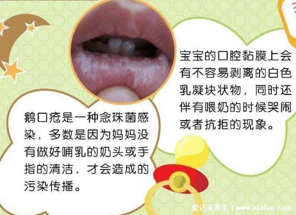 初早期嬰兒鵝口瘡圖片及癥狀圖，感染輕微不疼但可進食痛苦(類似奶快)