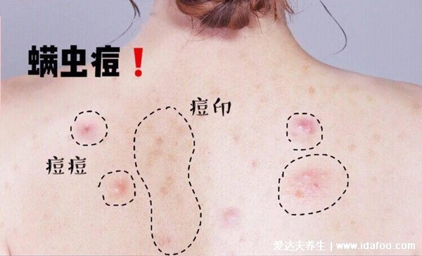 床上螨蟲咬的癥狀圖片，似蚊子包夜晚比白天瘙癢(螨蟲最怕這3種東西)