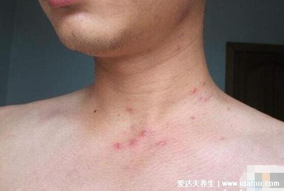 男性艾滋病的10個征兆，注意異常的初期癥狀和身體反應