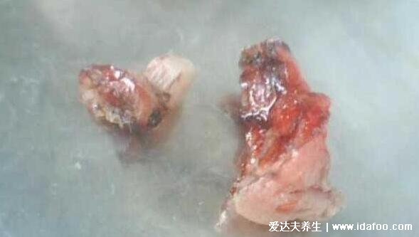 痔瘡長什么樣子的圖片，真實的輕微痔瘡圖片大全