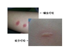 床螨叮咬的癥狀圖片，像晚上比白天癢的