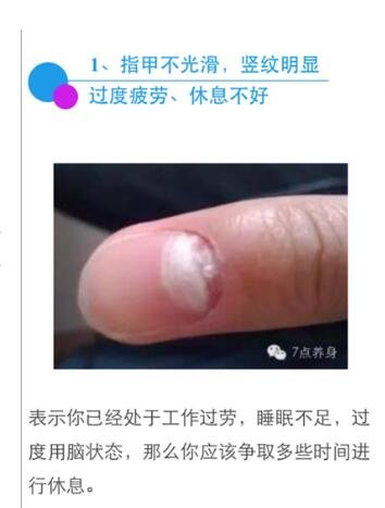 指甲有豎紋是身體的什么信號圖片，指甲豎紋當心三大疾病(注意顏色)