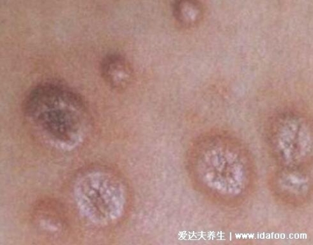 尖銳濕尤圖癥狀圖片男性癥狀，隱私部位現菜花狀疣體(潛伏期多在3個月)