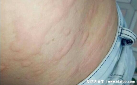 人體100種皮膚病對照圖癥狀及名稱，皮膚病種類及對應圖片大片