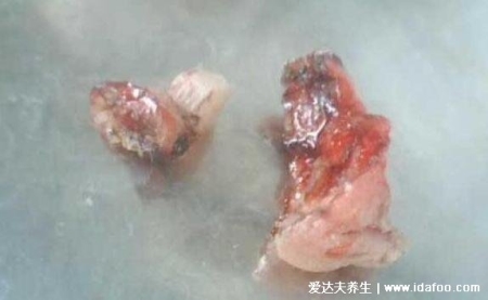 怎么判斷自己是不是長了痔瘡，真實的輕微痔瘡圖片大全