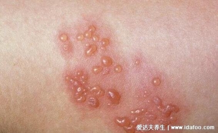 皮膚病圖片對照大全查看圖片，包含100種疾病的癥狀圖自測