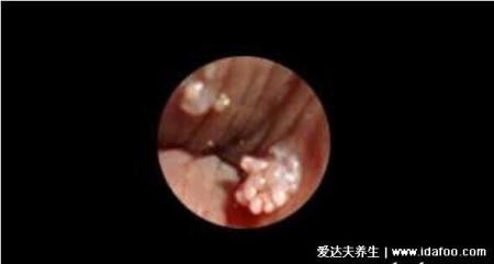 尖銳濕尤圖癥狀圖片男性癥狀，隱私部位現菜花狀疣體(潛伏期多在3個月)
