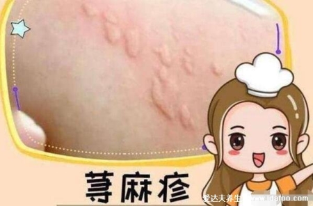 風疹塊止癢小妙招，蕁麻疹最怕四個土方法(黑芝麻酒見效超快)