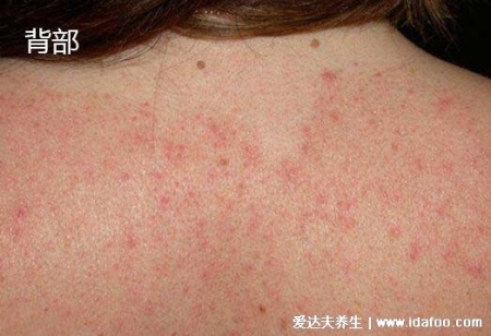 皮膚病圖片對照大全查看圖片，包含100種疾病的癥狀圖自測