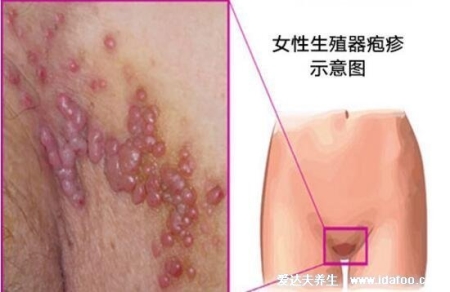 女人艾滋病的三大癥狀圖片，對比艾滋病初期小紅點照片自查