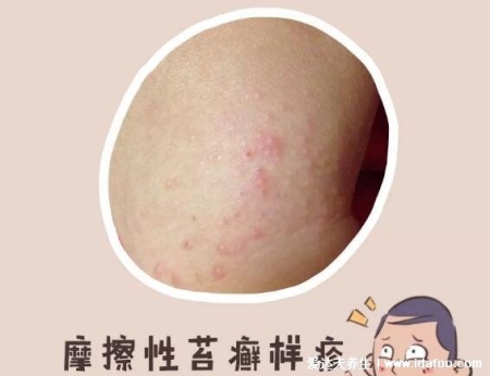 皮膚病圖片對照大全查看圖片，包含100種疾病的癥狀圖自測