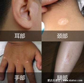 皮膚病圖片對照大全查看圖片，包含100種疾病的癥狀圖自測