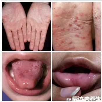 人體100種皮膚病對照圖癥狀及名稱，皮膚病種類及對應圖片大片