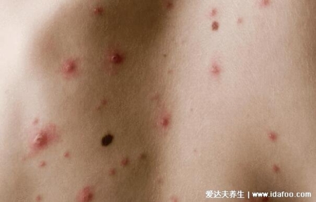 女人艾滋病的三大癥狀圖片，對比艾滋病初期小紅點照片自查