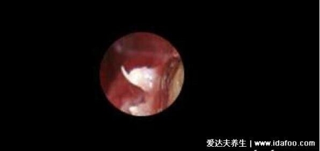 尖銳濕尤圖癥狀圖片男性癥狀，隱私部位現菜花狀疣體(潛伏期多在3個月)