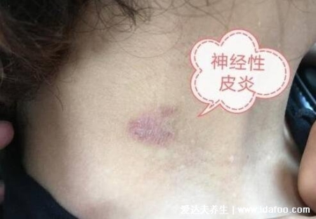 皮膚病圖片對照大全查看圖片，包含100種疾病的癥狀圖自測