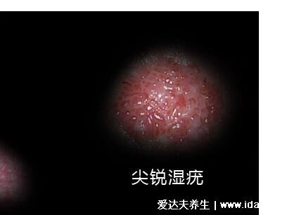 尖銳濕尤圖癥狀圖片男性癥狀，隱私部位現菜花狀疣體(潛伏期多在3個月)
