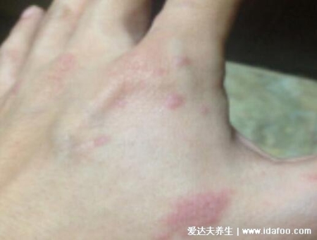 人體100種皮膚病對照圖癥狀及名稱，皮膚病種類及對應圖片大片