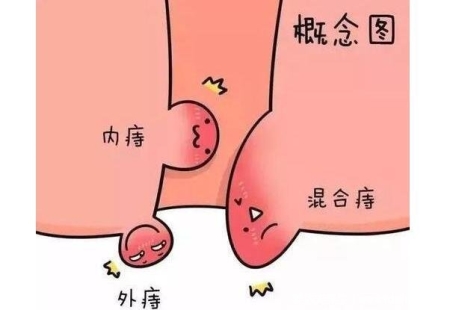怎么判斷自己是不是長了痔瘡，真實的輕微痔瘡圖片大全