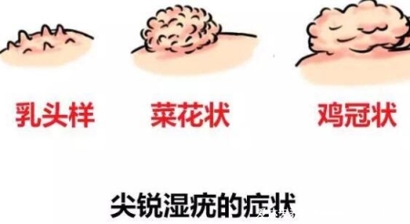 尖銳濕尤圖癥狀圖片男性癥狀，隱私部位現菜花狀疣體(潛伏期多在3個月)