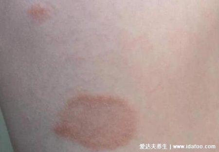 人體100種皮膚病對照圖癥狀及名稱，皮膚病種類及對應圖片大片