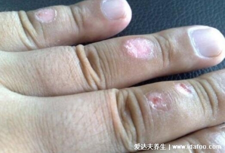 皮膚病圖片對照大全查看圖片，包含100種疾病的癥狀圖自測