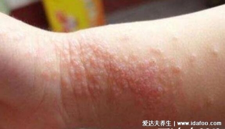 人體100種皮膚病對照圖癥狀及名稱，皮膚病種類及對應圖片大片